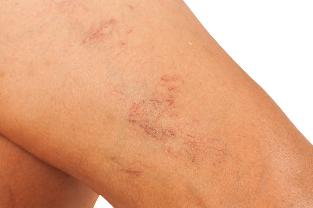 close-up of woman's leg prior to receiving vein therapy - sclerotherapy