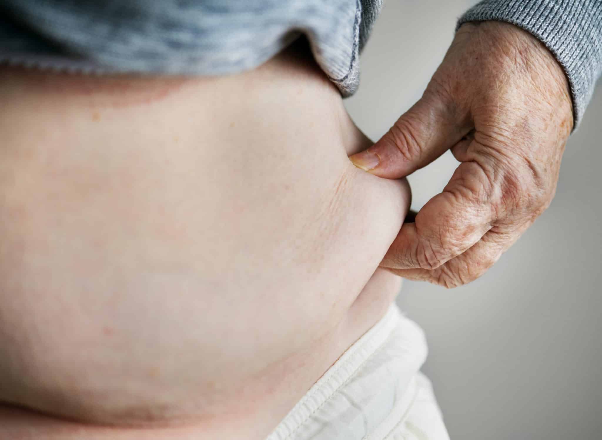 Closeup of obese senior citizen pinching midsection